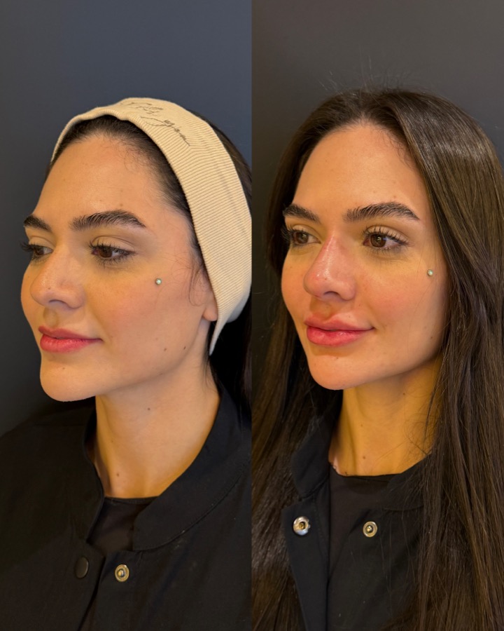 Resultado antes e depois NBM