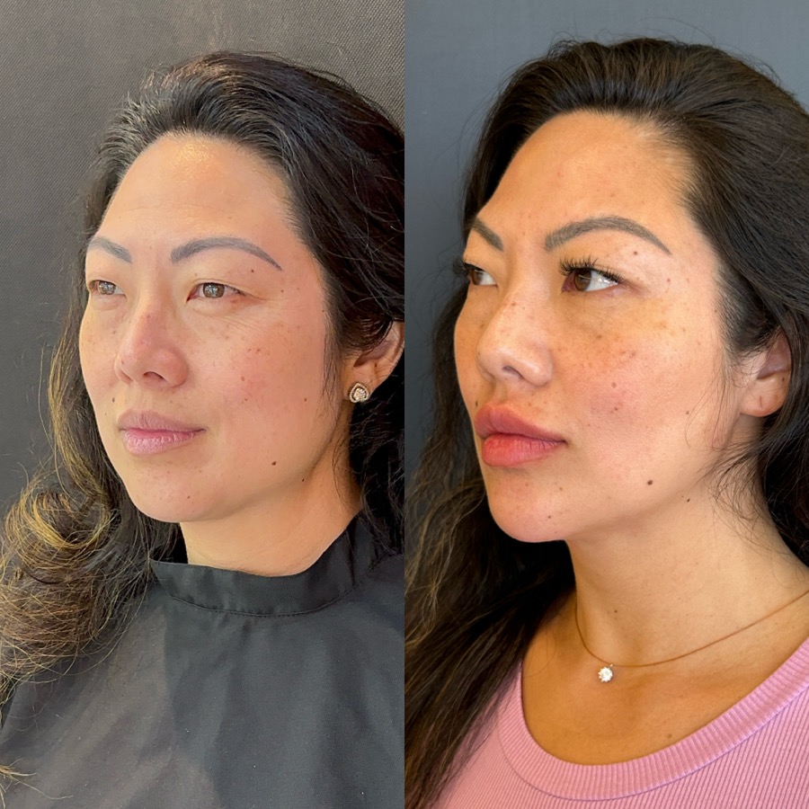 Resultado antes e depois NBM
