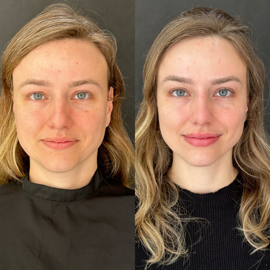 Resultado antes e depois NBM