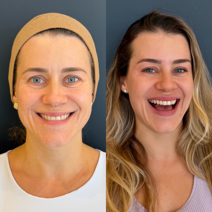 Resultado antes e depois NBM
