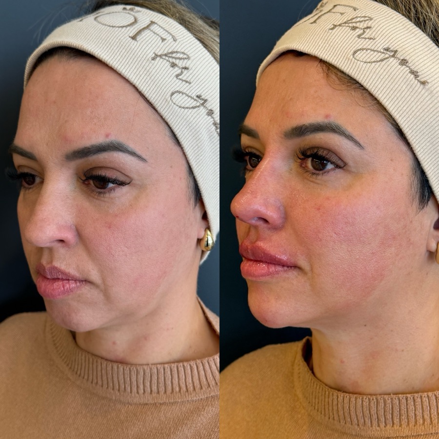 Resultado antes e depois NBM