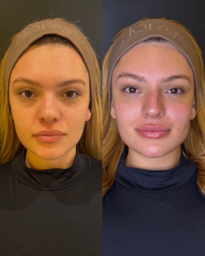 Resultado antes e depois NBM