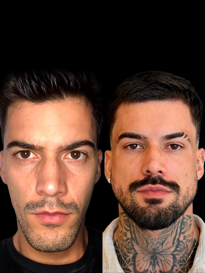 Resultado antes e depois NBM