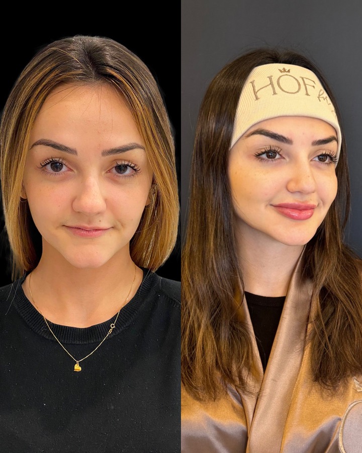 Resultado antes e depois NBM