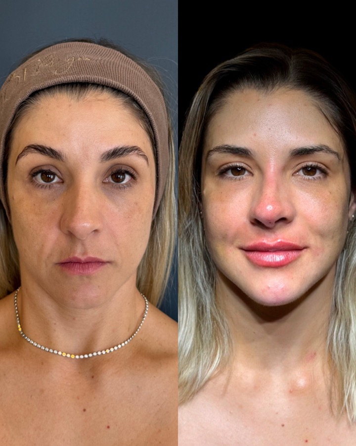 Resultado antes e depois NBM